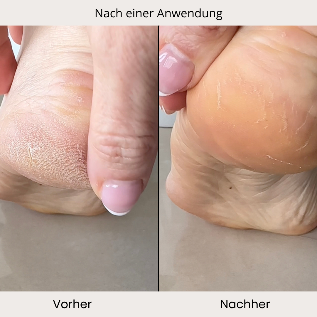 Ferse nach einer Anwendung