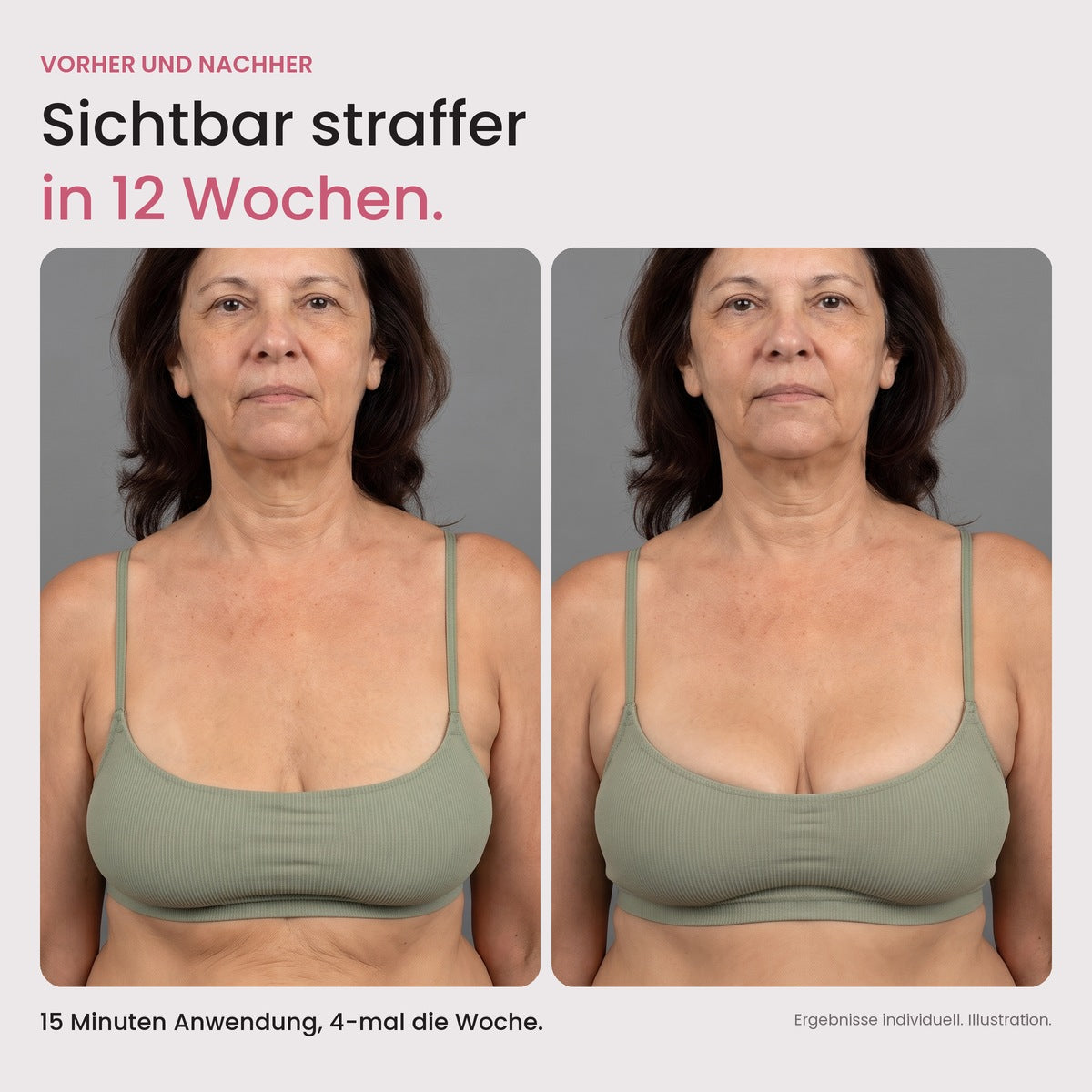 CellaLift vorher und nachher: sichtbar straffer in 12 Wochen (Illustration)